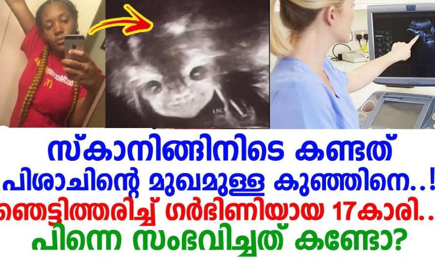 ഗർഭകാലത്തെ പിശാചിന്റെ മുഖമുള്ള കുഞ്ഞിനെ കണ്ടു ഞെട്ടി അമ്മ. കുഞ്ഞിനെ കണ്ട അമ്മ ചെയ്തത് നോക്കൂ.